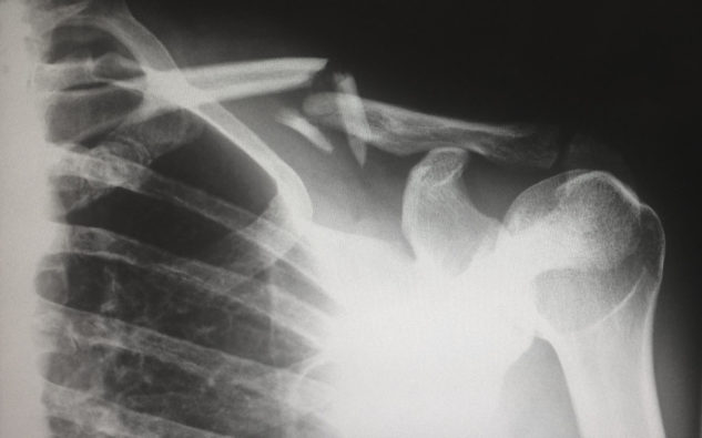 Zlomená klíční kost patří mezi častá hokejová zranění.